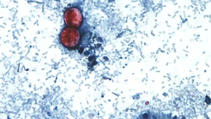 More than 3,000 people in Michigan and Ohio have gotten severe diarrhea, bloating and cramping caused by the microscopic Cyclospora parasite.