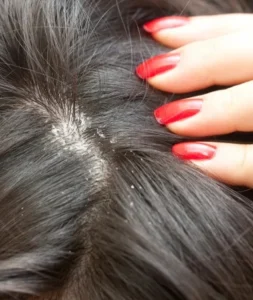 Dandruff 